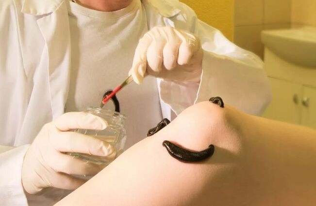 Hirudotherapy για κιρσοί φλέβες