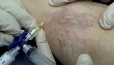 σκληροθεραπεία για κιρσούς