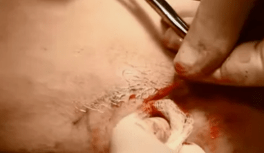 τύποι επεμβάσεων για την αφαίρεση κιρσών